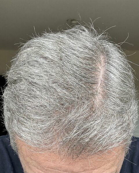 Coronilla con mayoría de canas antes del tónico
