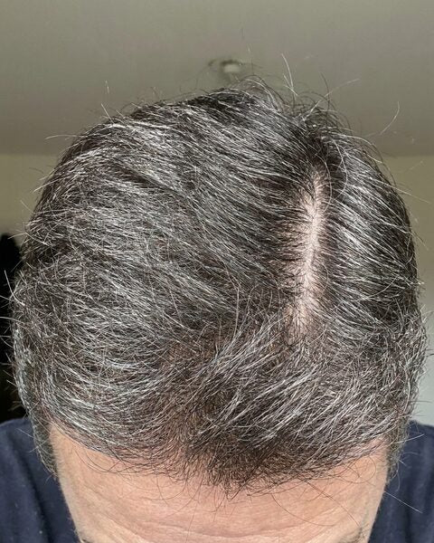 Coronilla con las canas en minoría después del tónico
